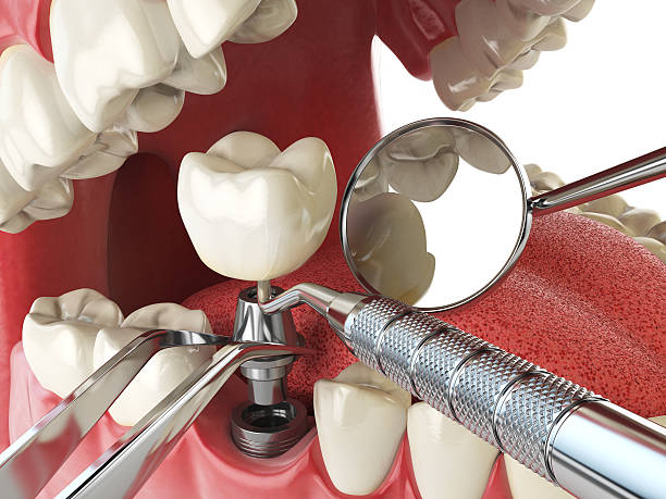 Best Emergency Dental Care for Broken or Chipped Teeth in Three Rivers, OR
